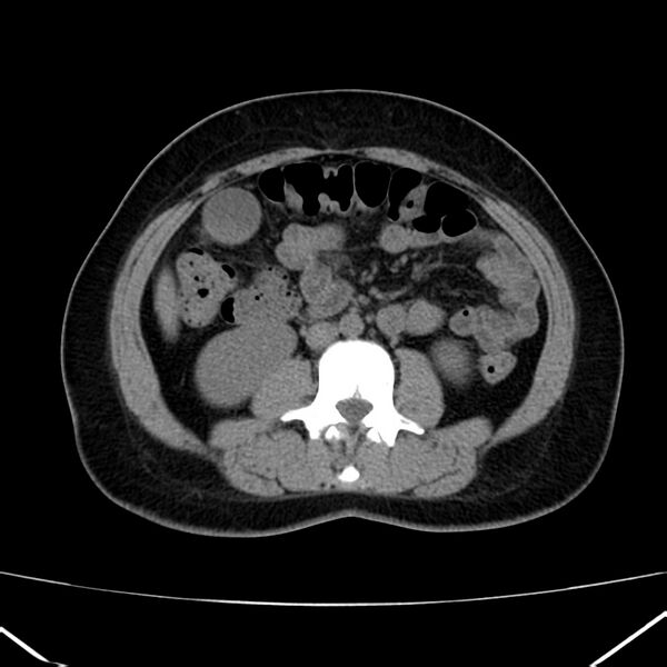 File:Ampullary tumor (Radiopaedia 22787-22816 Axial non-contrast 29).jpg