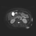 Ampullary tumor (Radiopaedia 27294-27479 T2 SPAIR 5).jpg