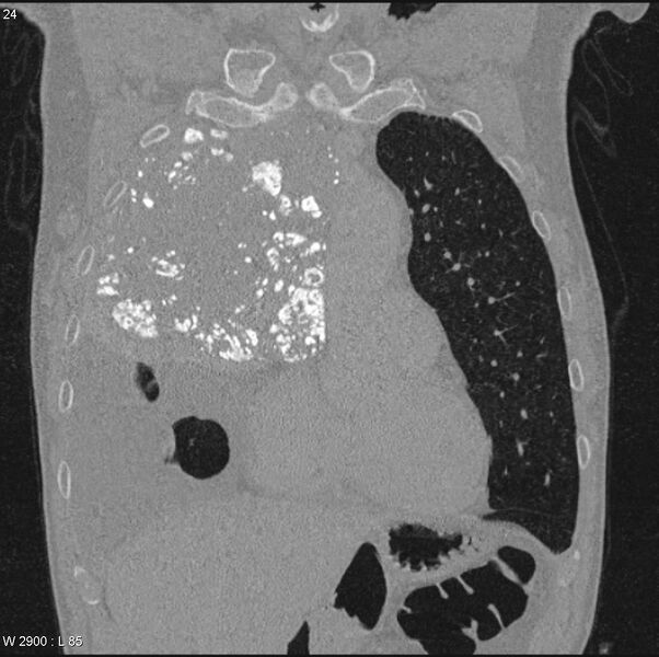 File:Amyloidoma - mediastinal (Radiopaedia 6711-7925 Coronal bone window 4).jpg
