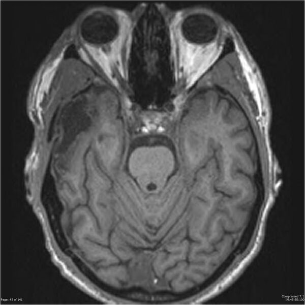 File:Anaplastic meningioma with recurrence (Radiopaedia 34452-35788 Axial T1 43).jpg