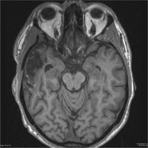 File:Anaplastic meningioma with recurrence (Radiopaedia 34452-35788 Axial T1 48).jpg