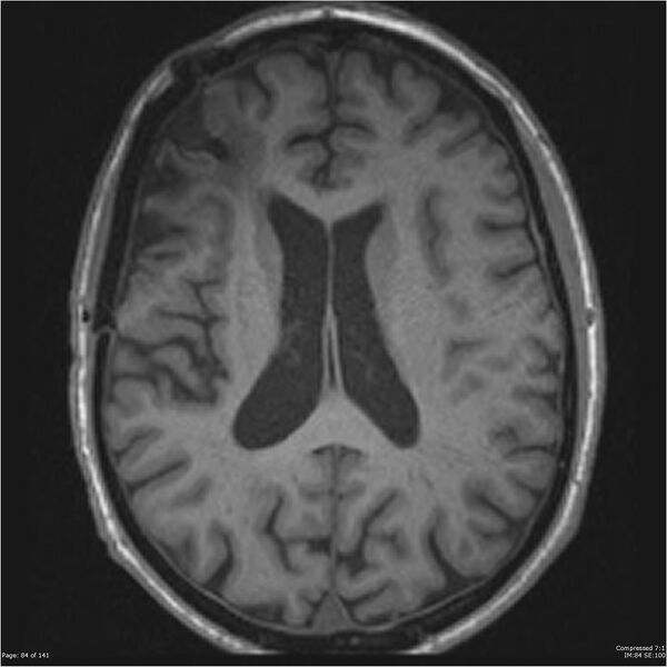File:Anaplastic meningioma with recurrence (Radiopaedia 34452-35788 Axial T1 82).jpg