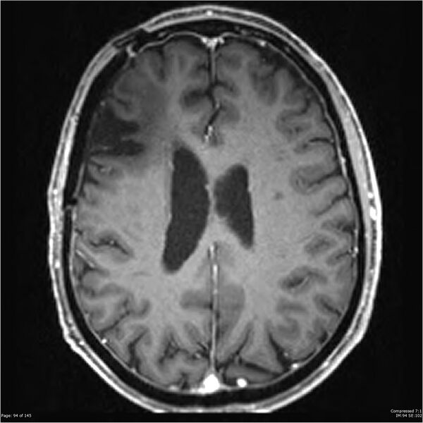 File:Anaplastic meningioma with recurrence (Radiopaedia 34452-35788 Axial T1 C+ 94).jpg