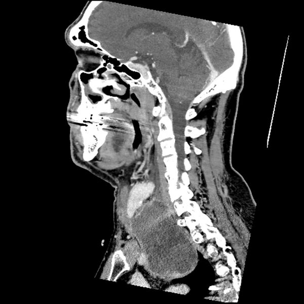 File:Anaplastic thyroid carcinoma (Radiopaedia 79087-92034 C 41).jpg