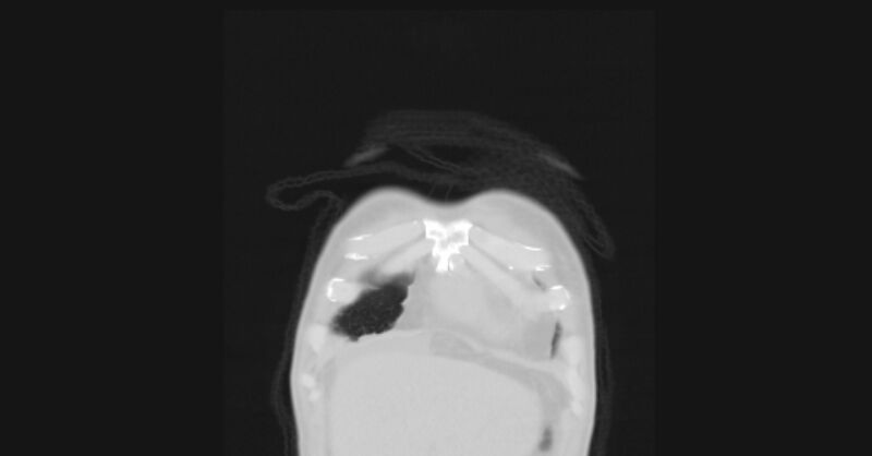 File:Angioinvasive aspergellosis (Radiopaedia 66995-76315 Coronal lung window 1).jpg