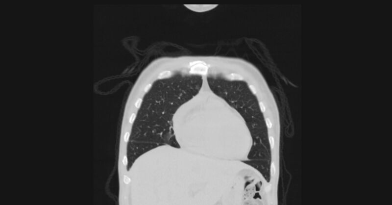 File:Angioinvasive aspergellosis (Radiopaedia 66995-76315 Coronal lung window 12).jpg