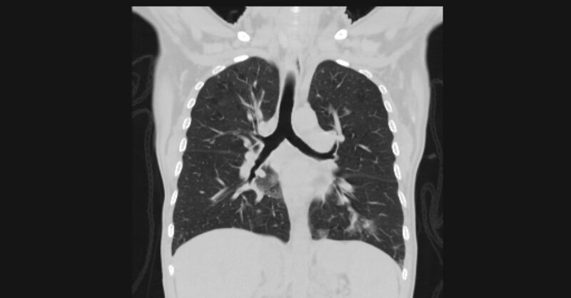 File:Angioinvasive aspergellosis (Radiopaedia 66995-76315 Coronal lung window 35).jpg