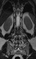 Ankylosing spondylitis - Andersson lesion (Radiopaedia 81878-95838 Coronal T2 11).jpg
