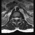 Ankylosing spondylitis with zygapophyseal arthritis (Radiopaedia 38433-40516 Axial T2 19).jpg