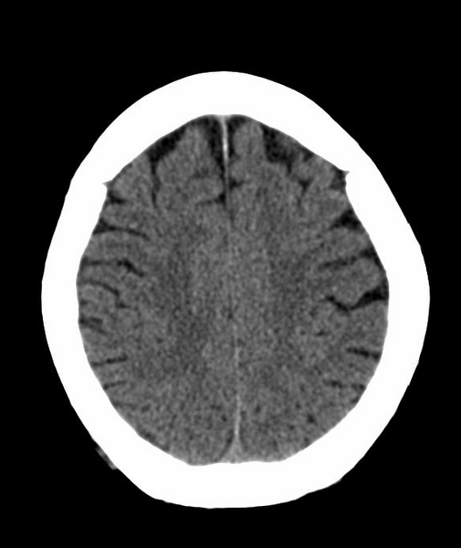 File:Anomalous intracranial venous drainage (Radiopaedia 28161-28418 Axial 40).png