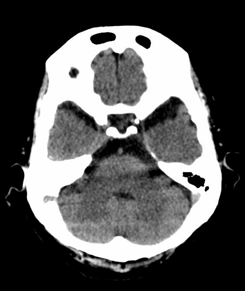 File:Anomalous intracranial venous drainage (Radiopaedia 28161-28418 Axial 43).png