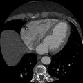 Anomalous origin of left circumflex artery from right coronary sinus (Radiopaedia 72563-83117 B 114).jpg
