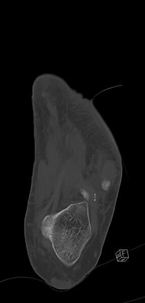 File:Anterior calcaneal process fracture (Radiopaedia 63353-71943 Coronal bone window 35).jpg