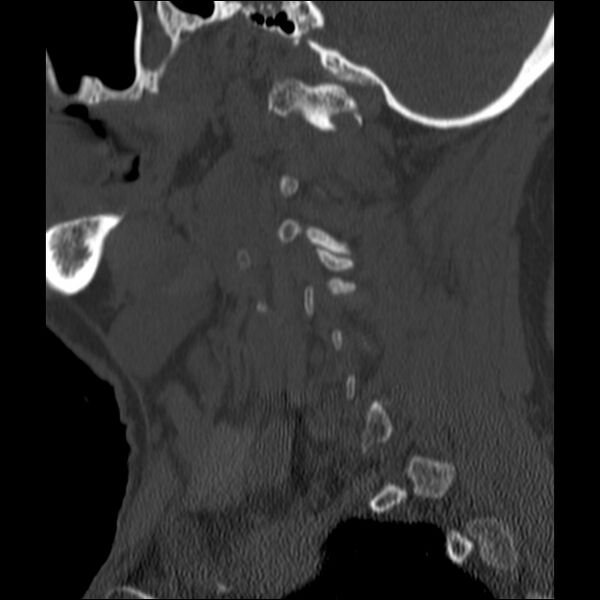 File:Anterior cervical postdiscectomy arthrodesis (Radiopaedia 32678-33646 Sagittal bone window 13).jpg