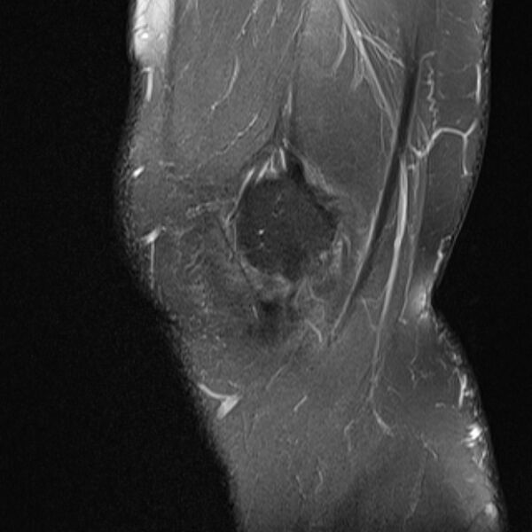 File:Anterior cruciate ligament tear - ramp lesion (Radiopaedia 71883-82322 Sagittal PD fat sat 23).jpg