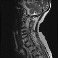 Anterior spinal artery syndrome (Radiopaedia 46335-50750 A 7).png