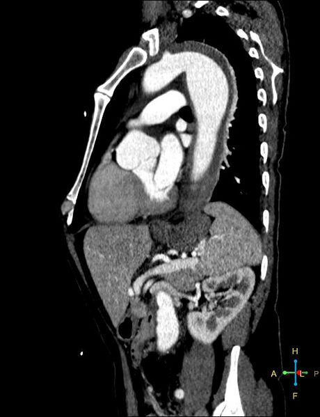 File:Aortic aneurysm and penetrating ulcer (Radiopaedia 23590-23704 C 6).jpg