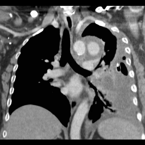File:Aortic arch false aneurysm (Radiopaedia 14667-14588 B 10).jpg