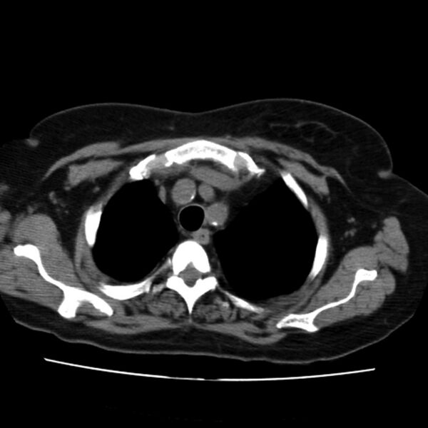 File:Aortic arch pseudoaneurysm (Radiopaedia 8534-9368 Axial non-contrast 11).jpg