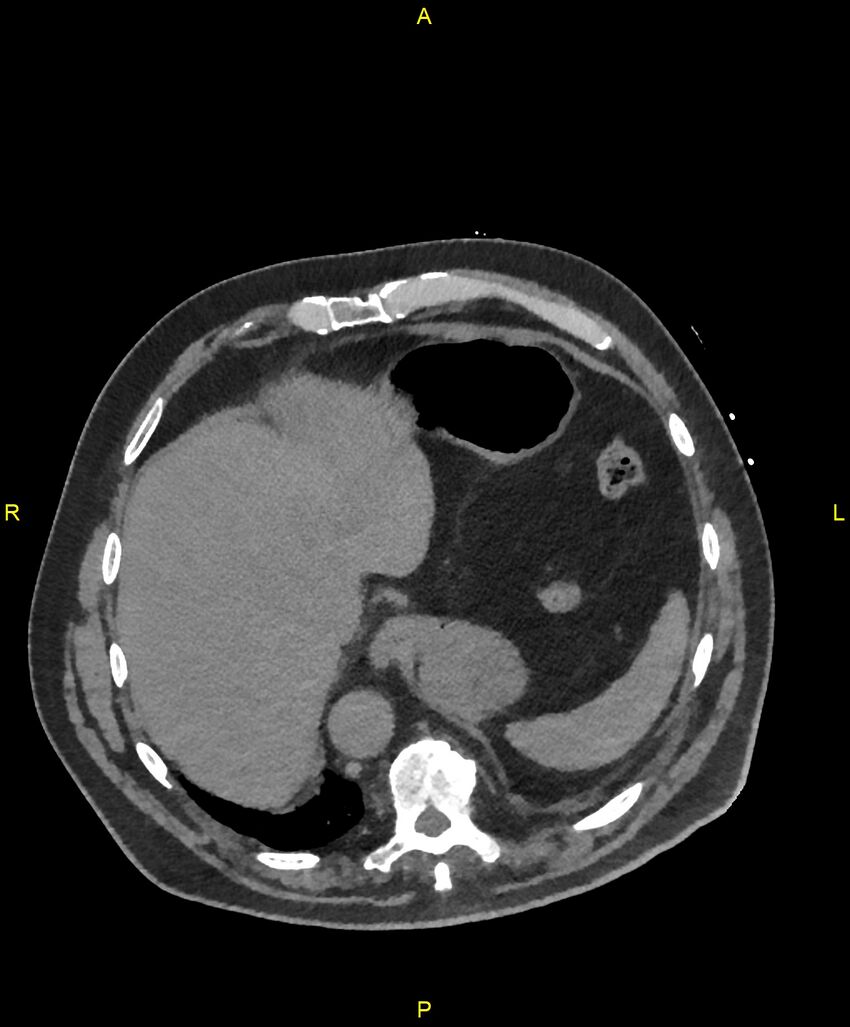 Aortic rupture (Radiopaedia 88822-105594 Axial non-contrast 207).jpg