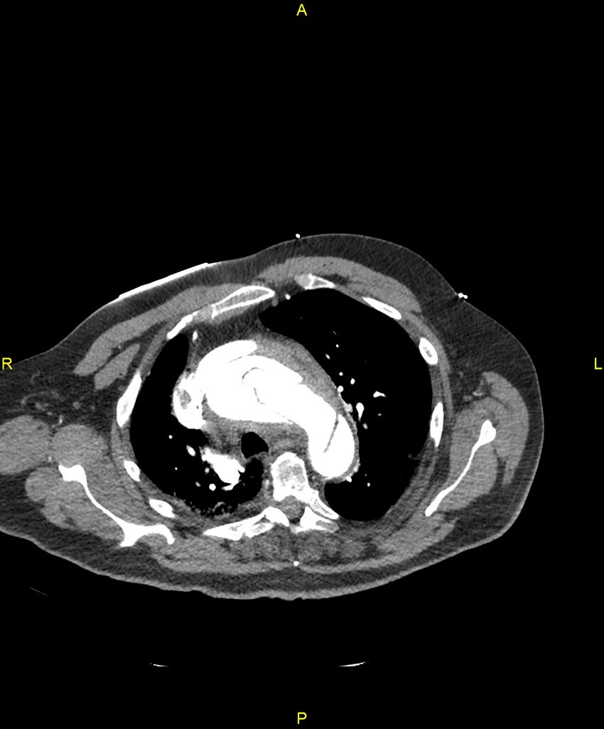 Aortic rupture (Radiopaedia 88822-105594 B 71).jpg