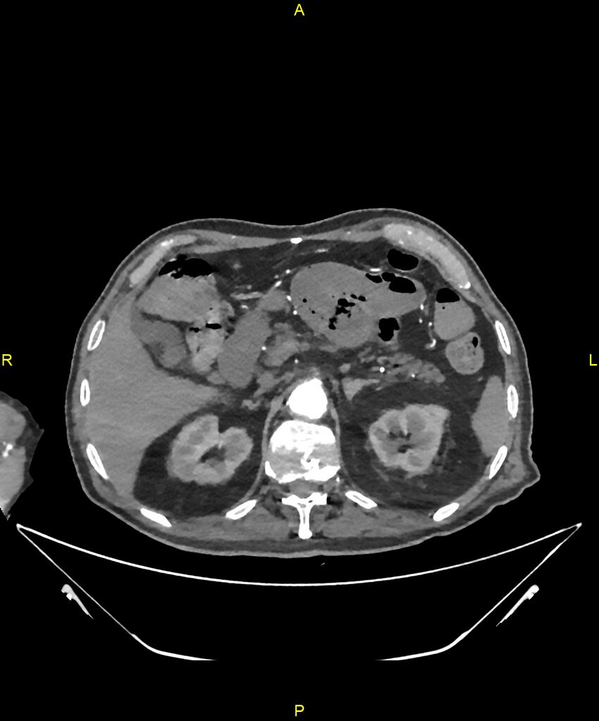 Aortoenteric fistula (Radiopaedia 84308-99603 B 88).jpg