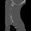 Apical pneumothorax on cervical spine CT (Radiopaedia 45343-49368 Sagittal bone window 3).jpg