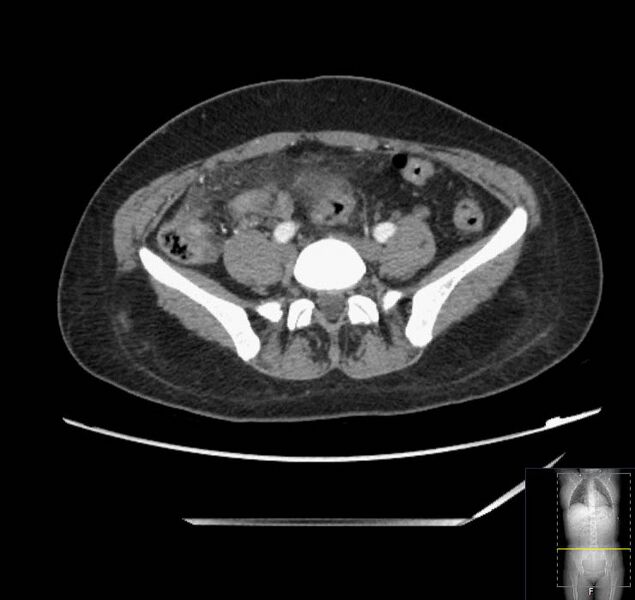 File:Appendicitis (CT angiogram) (Radiopaedia 154713-127660 Axial 23).jpg