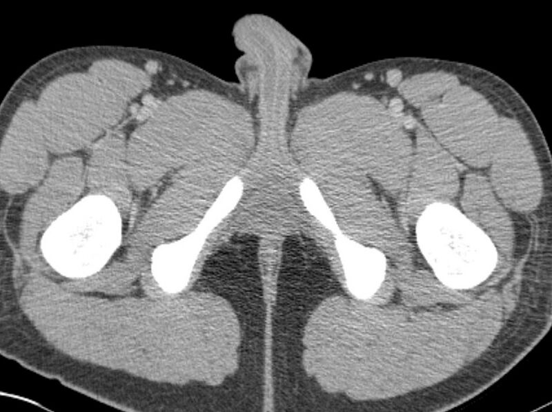 File:Appendicitis and incidental foregut duplication cyst (Radiopaedia 52962-58916 A 117).jpg