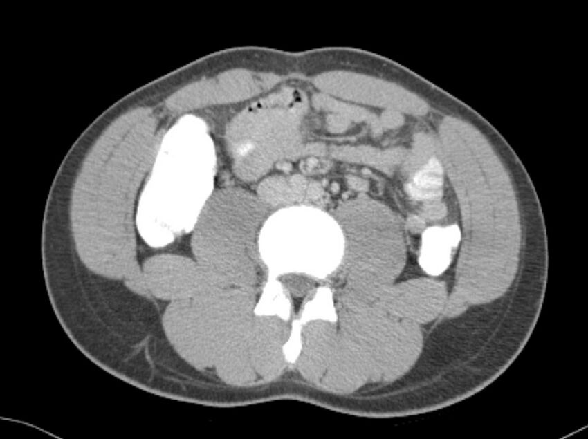 Appendicitis and incidental foregut duplication cyst (Radiopaedia 52962-58916 A 41).jpg
