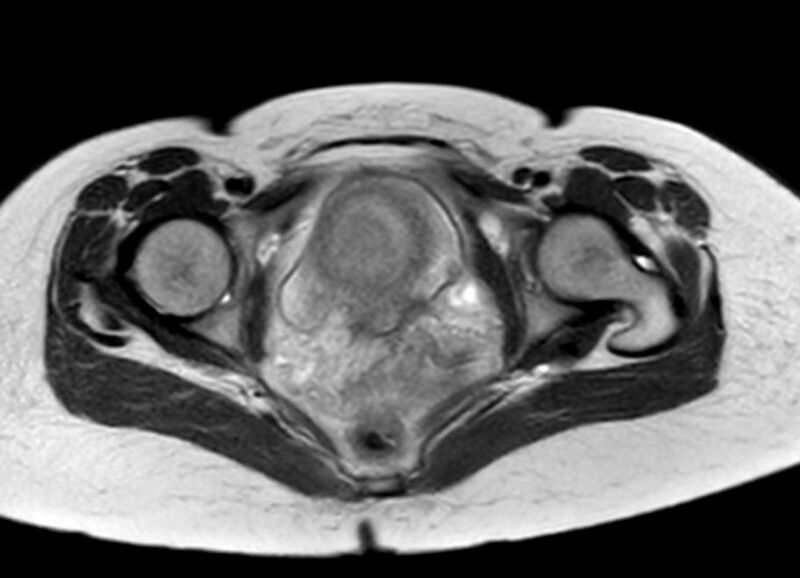 File:Appendicitis in gravida (MRI) (Radiopaedia 89433-106395 Axial T2 67).jpg