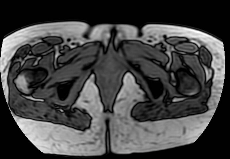 File:Appendicitis in gravida (MRI) (Radiopaedia 89433-106395 D 73).jpg