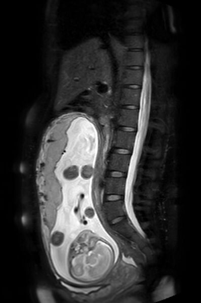File:Appendicitis in gravida (MRI) (Radiopaedia 89433-106395 Sagittal T2 SPAIR 32).jpg