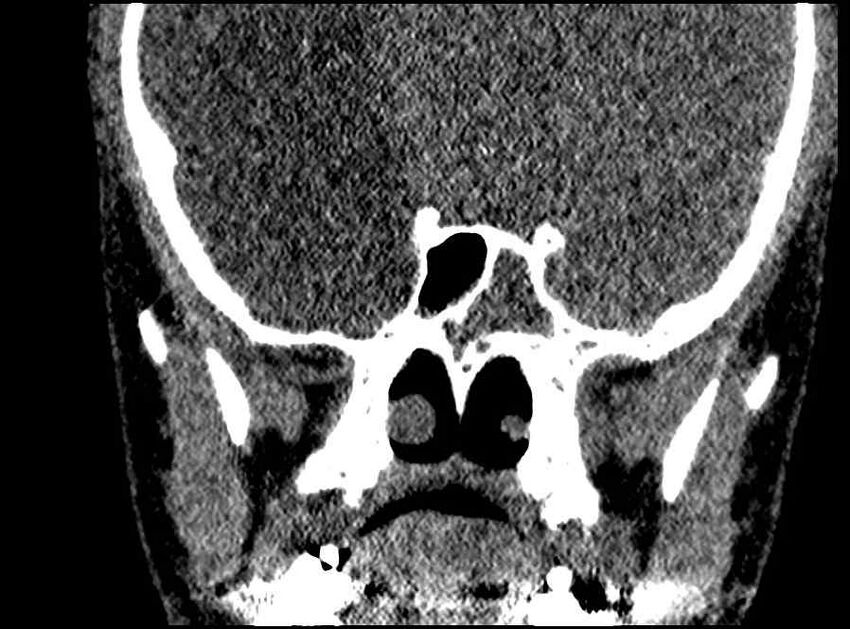Arachnoid cyst- extremely large (Radiopaedia 68741-78450 Coronal bone window 24).jpg
