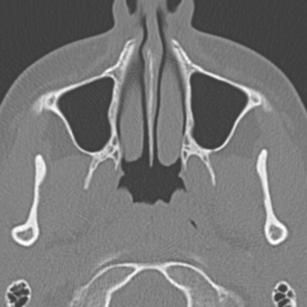 File:Arrested pneumatization of the sphenoid (Radiopaedia 10700-11172 Axial non-contrast 17).jpg