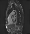 Arrhythmogenic right ventricular cardiomyopathy (Radiopaedia 57972-64966 Cine RVOT SSFP 23).jpg