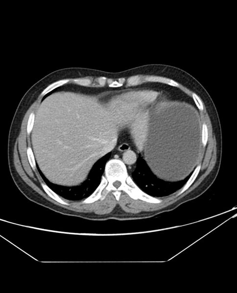 File:Arterial occlusive mesenteric ischemia (Radiopaedia 84641-100054 A 11).jpg