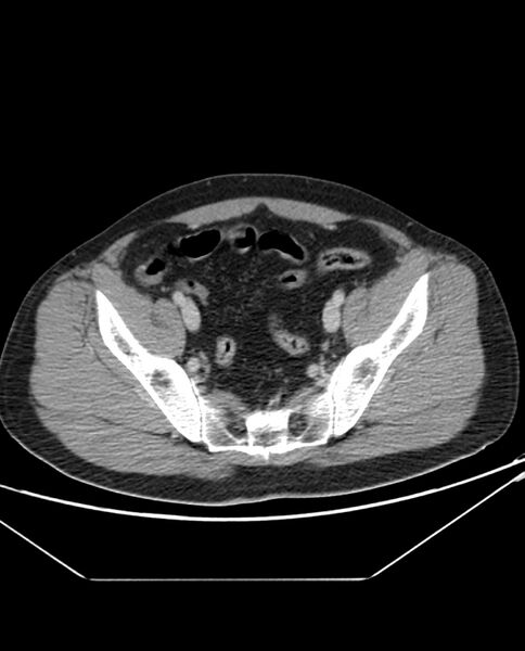 File:Arterial occlusive mesenteric ischemia (Radiopaedia 84641-100054 A 99).jpg