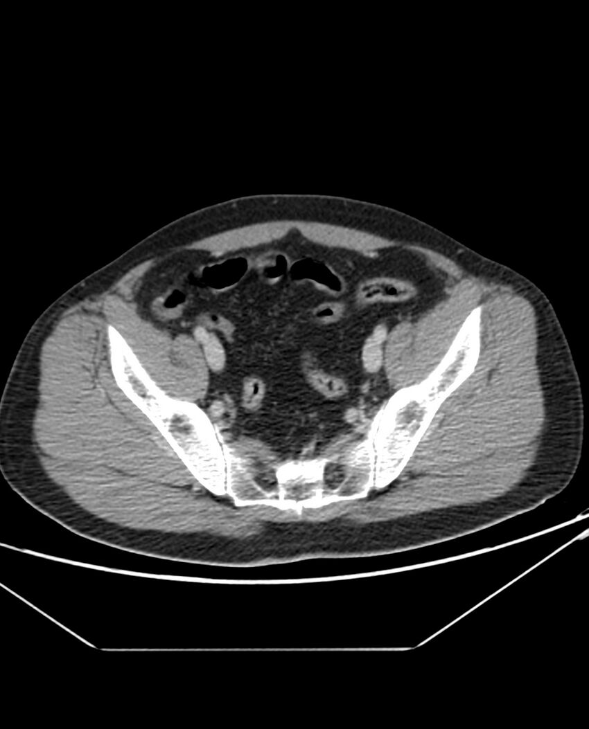 Arterial occlusive mesenteric ischemia (Radiopaedia 84641-100054 A 99).jpg