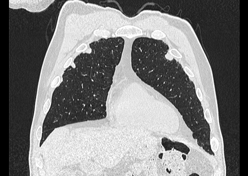 File:Asbestos pleural placques (Radiopaedia 57905-64872 Coronal lung window 53).jpg