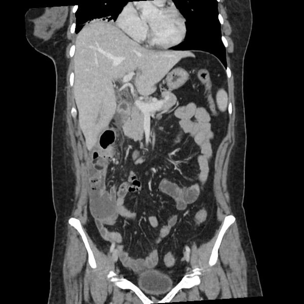 File:Ascending retrocecal appendicitis with liver abscesses (Radiopaedia 60066-67615 C 26).jpg