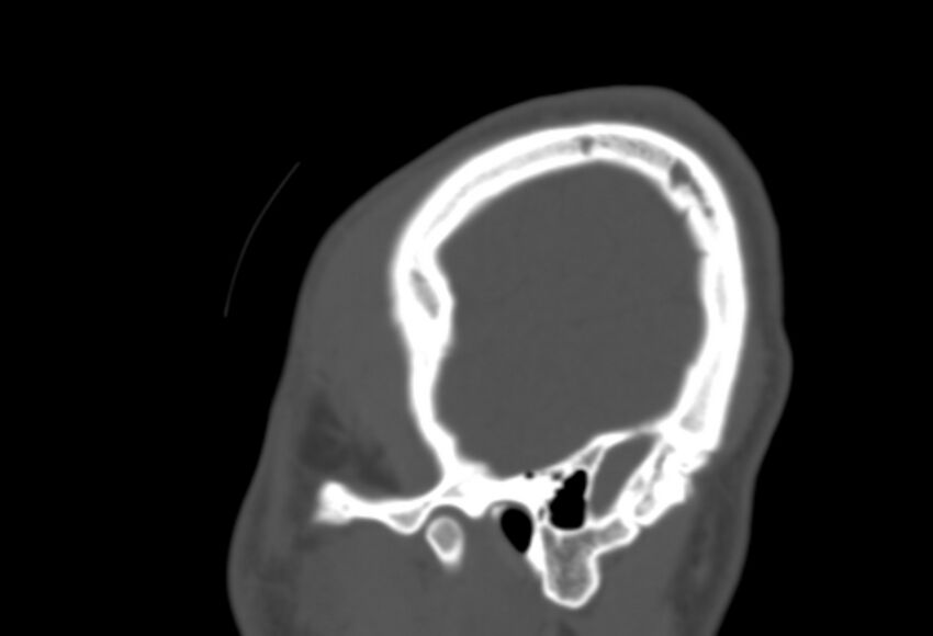Asymptomatic occipital spur (Radiopaedia 87753-104201 Sagittal bone window 289).jpg
