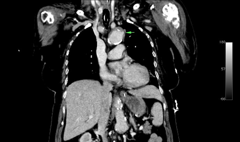 File:Atypical dissection of the thoracic aorta (Radiopaedia 10975-78320 B 14).jpg