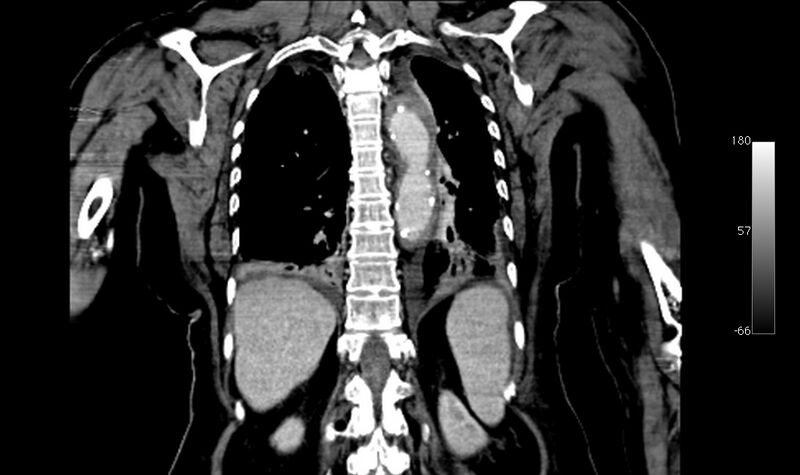 File:Atypical dissection of the thoracic aorta (Radiopaedia 10975-78320 B 35).jpg