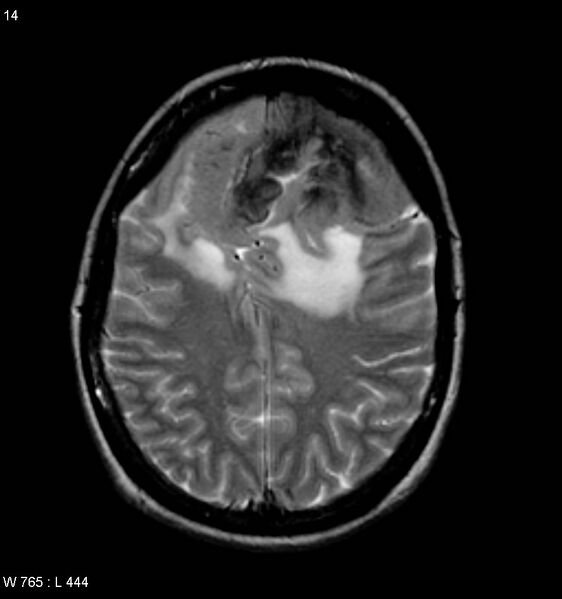 File:Atypical meningioma (WHO grade II) (Radiopaedia 7762-8586 Axial T2 6).jpg