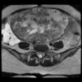 Atypical retroperitoneal lymphocoeles with large leiomyoma of uterus (Radiopaedia 32084-33027 Axial T2 10).jpg