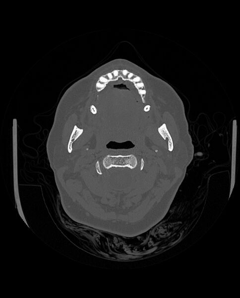 File:Automastoidectomy with labyrinthine fistula (Radiopaedia 84143-99411 Axial non-contrast 23).jpg