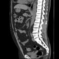 Autosomal dominant polycystic kidney disease (Radiopaedia 36539-38101 D 46).jpg