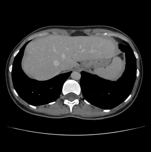 File:Autosomal dominant polycystic kidney disease - early onset (Radiopaedia 40734-43387 A 1).jpg