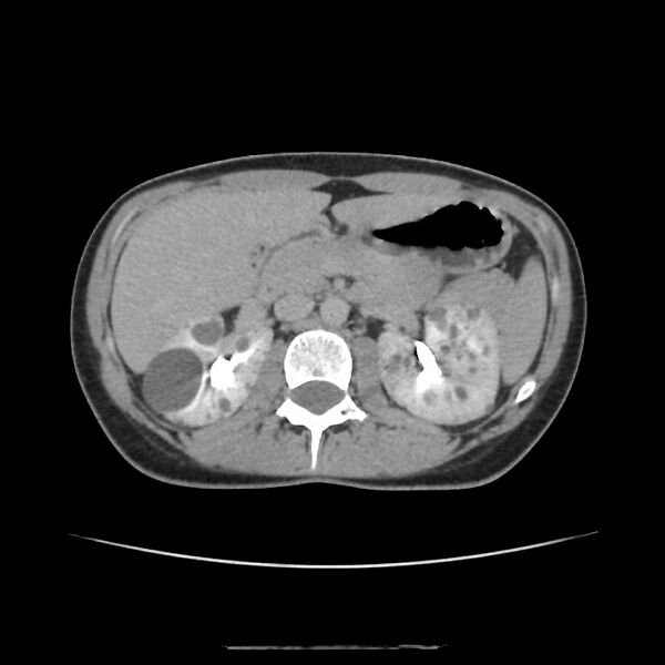 File:Autosomal dominant polycystic kidney disease - early onset (Radiopaedia 40734-43387 D 6).jpg